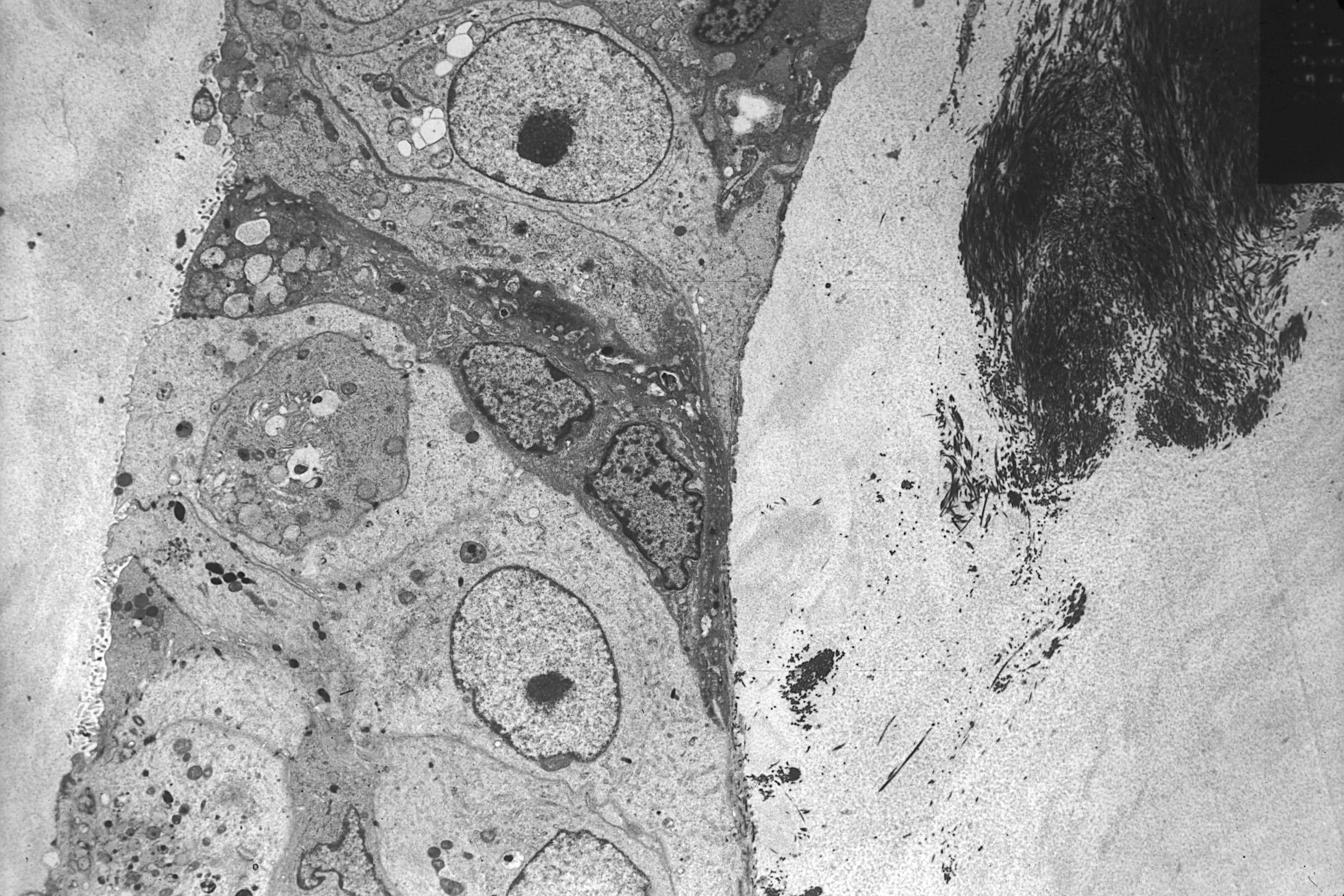 Electron microscope image of a breast cancer cell.