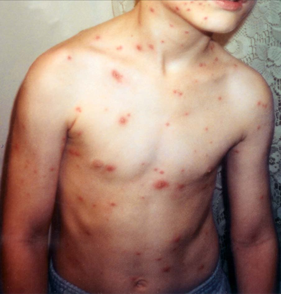 Child with a chickenpox rash showing scattered red spots and blisters on the face and upper body.