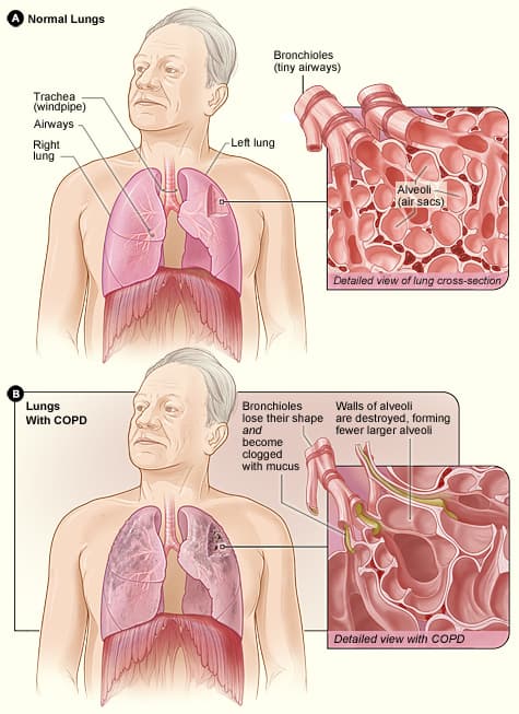 Diagram comparing healthy lungs with lungs affected by chronic obstructive pulmonary disease.