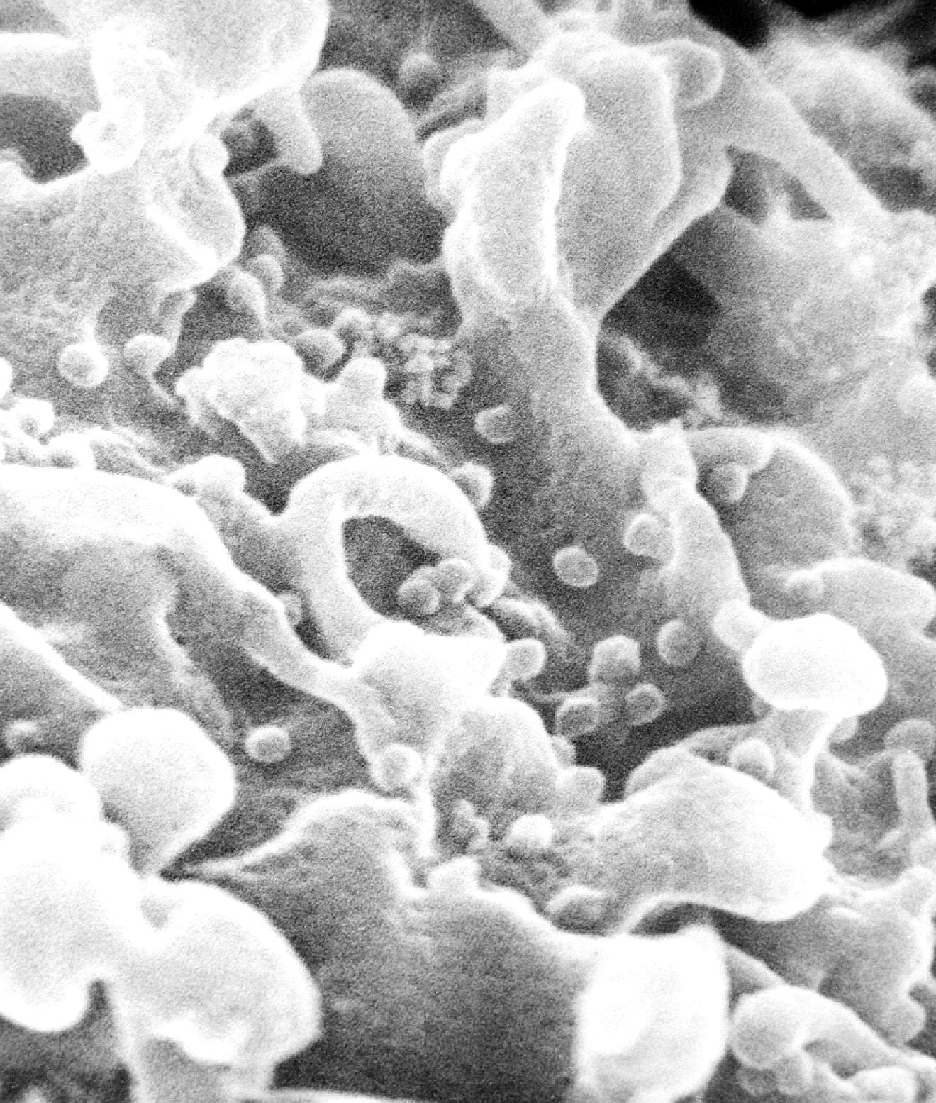 Scanning electron micrograph showing HIV particles budding from an infected immune cell.