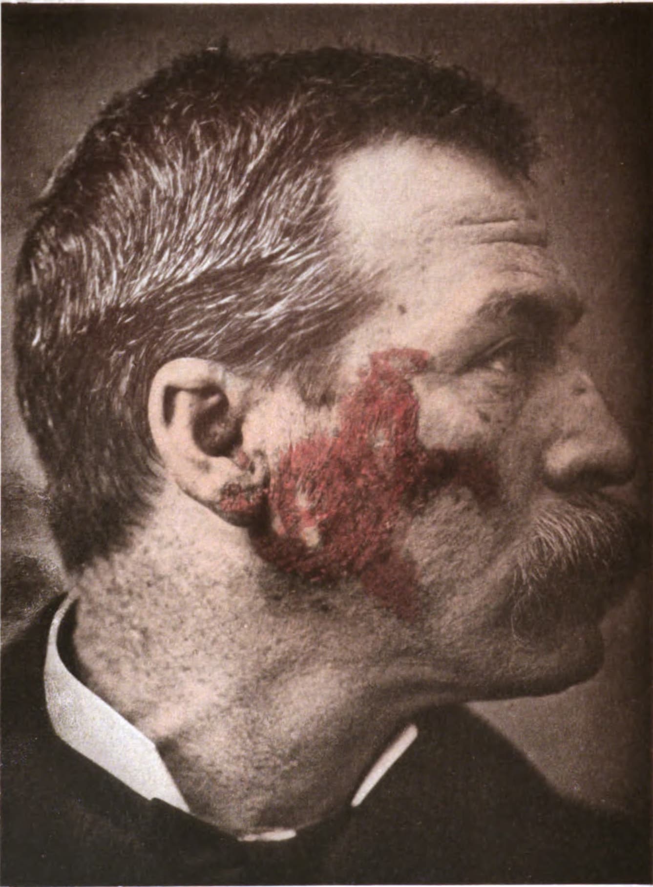 Historical medical image showing facial skin changes labeled as lupus erythematosus.