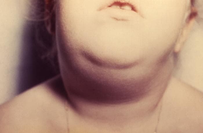 Child with swelling in the neck and jaw area caused by enlarged salivary glands during mumps infection.