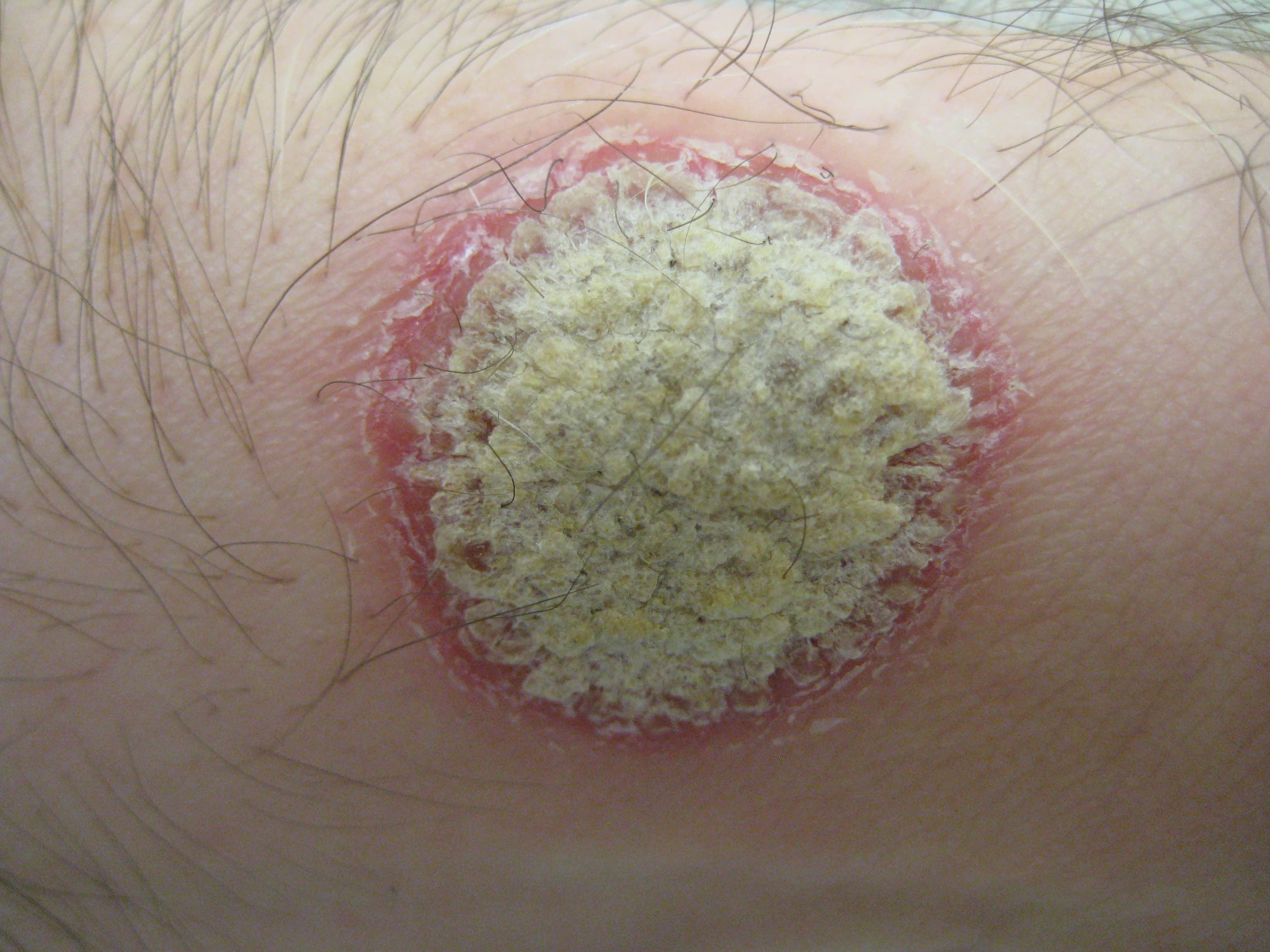 A plaque of psoriasis on human skin.