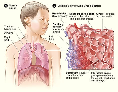 Diagram showing normal lung structure, airways, alveoli, and blood vessels.
