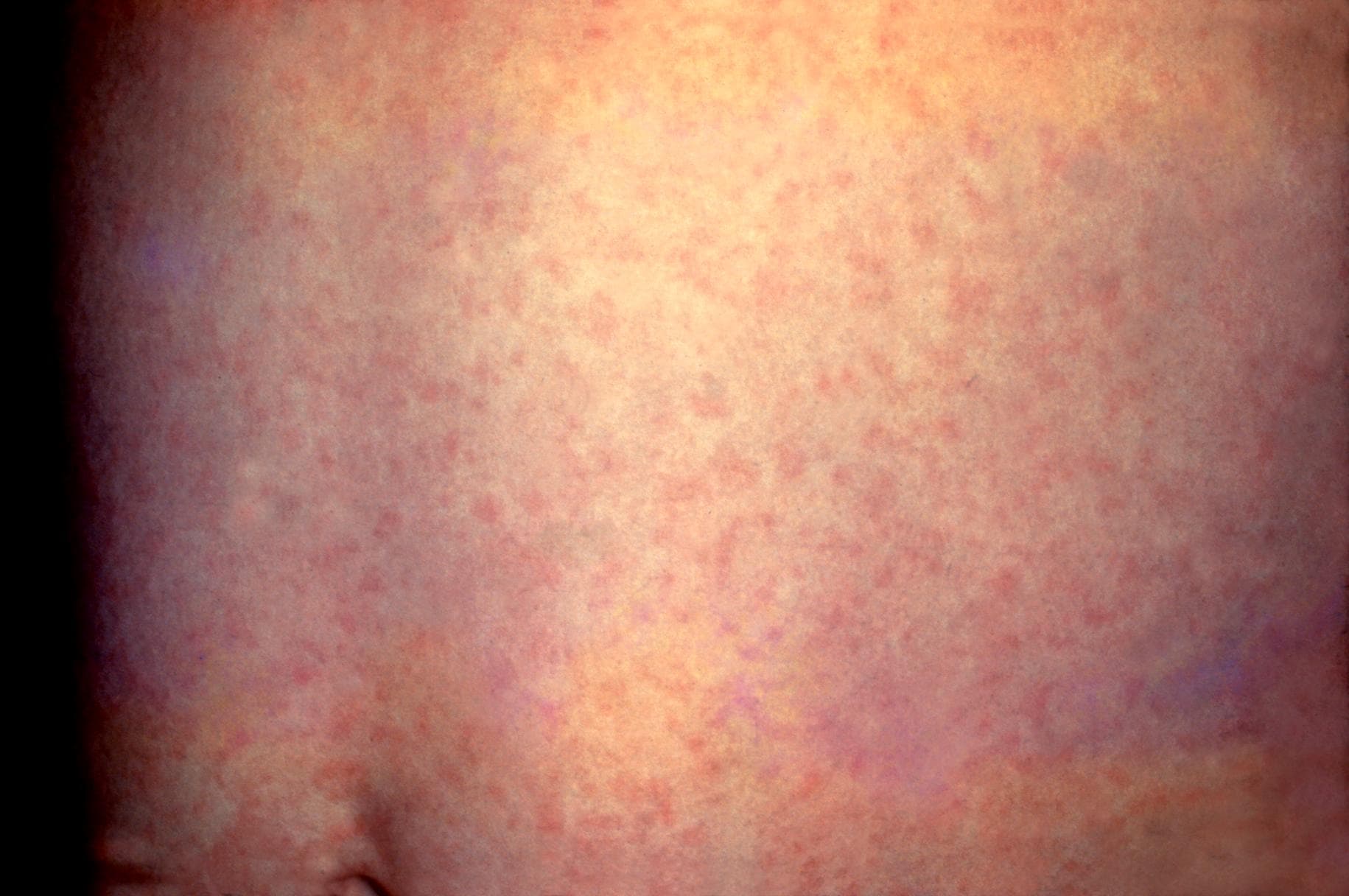 Generalized rash on the abdomen caused by rubella.