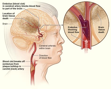 Illustration of an ischemic stroke caused by a blood clot blocking an artery in the brain.